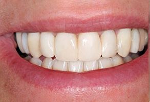 The image shows a close-up of a person s teeth with a bright smile.