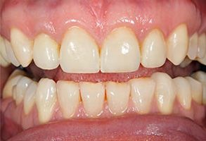 The image shows a close-up of a person s teeth with a pink gumline, displaying yellowish stains and signs of decay on some teeth, and possibly an orthodontic appliance in the upper front area.