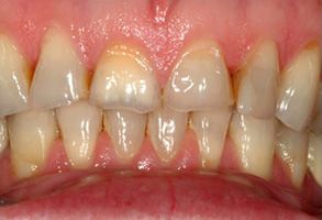 The image shows a close-up view of a person s teeth with visible discoloration and staining, with one side of the teeth appearing cleaner than the other.